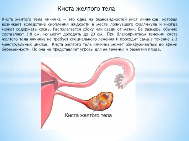 Киста желтого тела Киста желтого тела яичника — это одна из