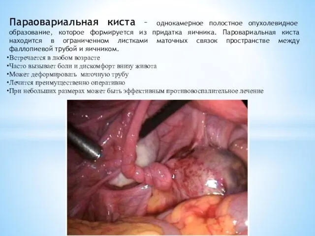 Параовариальная киста – однокамерное полостное опухолевидное образование, которое формируется из придатка