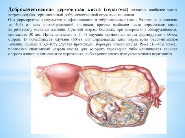 Доброкачественная дермоидная киста (тератома) является наиболее часто встречающейся герминогенной доброкачественной опухолью