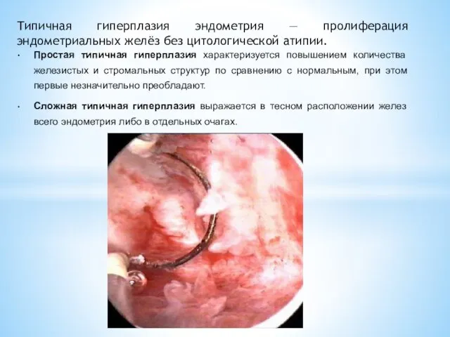 Типичная гиперплазия эндометрия — пролиферация эндометриальных желёз без цитологической атипии. Простая