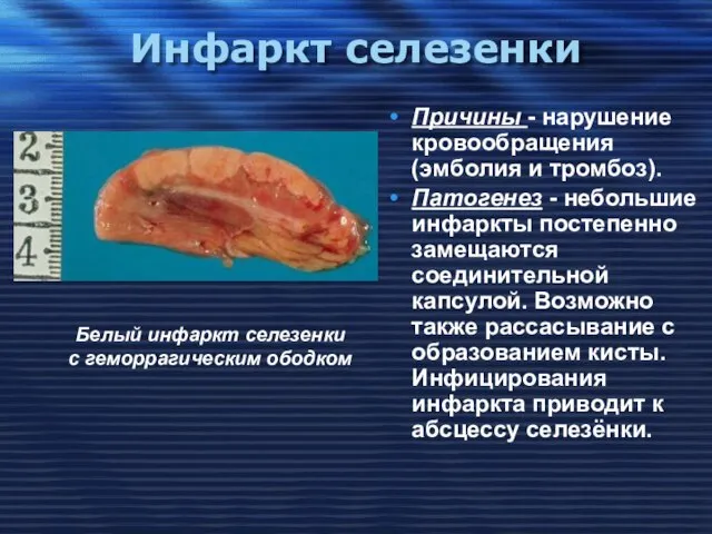 Инфаркт селезенки Причины - нарушение кровообращения (эмболия и тромбоз). Патогенез -