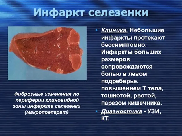 Инфаркт селезенки Клиника. Небольшие инфаркты протекают бессимптомно. Инфаркты больших размеров сопровождаются