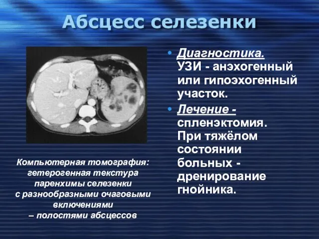 Абсцесс селезенки Диагностика. УЗИ - анэхогенный или гипоэхогенный участок. Лечение -