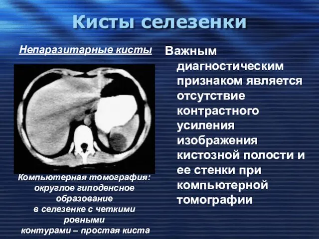 Кисты селезенки Важным диагностическим признаком является отсутствие контрастного усиления изображения кистозной