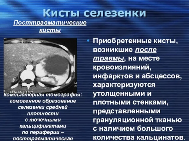 Кисты селезенки Приобретенные кисты, возникшие после травмы, на месте кровоизлияний, инфарктов