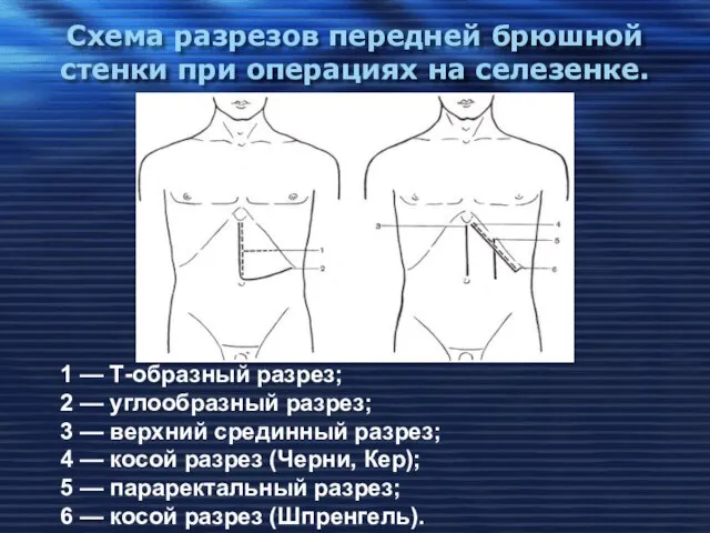 Схема разрезов передней брюшной стенки при операциях на селезенке. 1 —