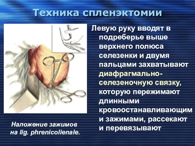 Техника спленэктомии Левую руку вводят в подреберье выше верхнего полюса селезенки