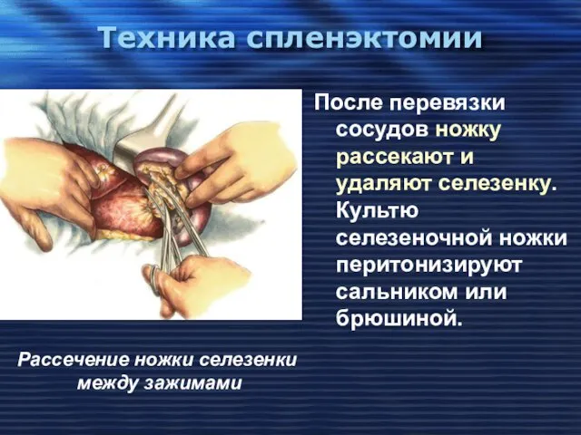 Техника спленэктомии После перевязки сосудов ножку рассекают и удаляют селезенку. Культю