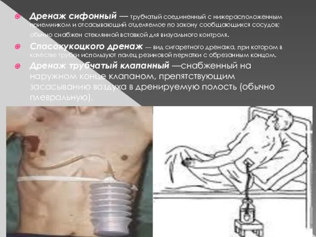 Дренаж сифонный — трубчатый соединенный с нижерасположенным приемником и отсасывающий отделяемое