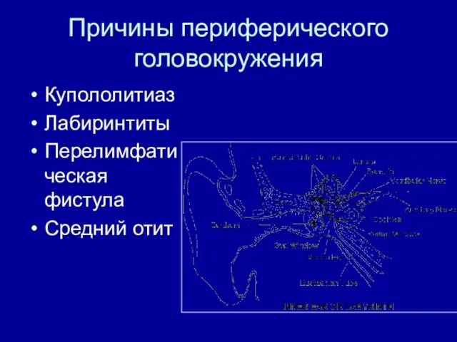 Причины периферического головокружения Купололитиаз Лабиринтиты Перелимфатическая фистула Средний отит