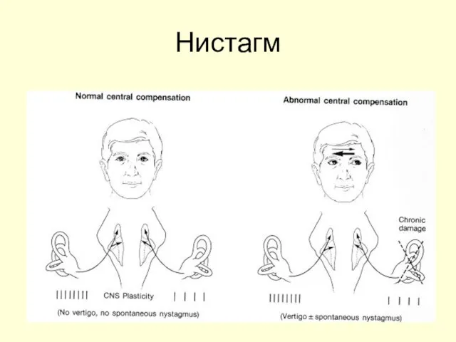 Нистагм