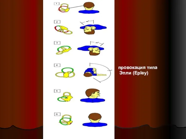 провокация типа Эпли (Epley)