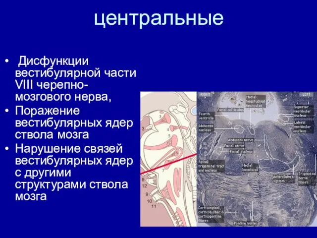 центральные Дисфункции вестибулярной части VIII черепно-мозгового нерва, Поражение вестибулярных ядер ствола