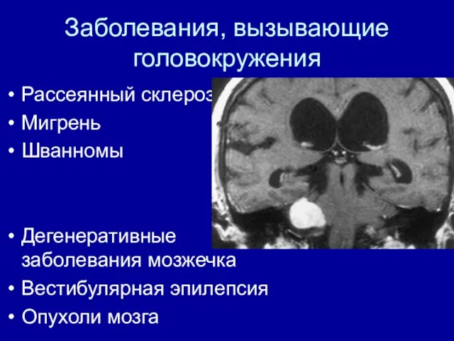 Заболевания, вызывающие головокружения Рассеянный склероз Мигрень Шванномы Дегенеративные заболевания мозжечка Вестибулярная эпилепсия Опухоли мозга