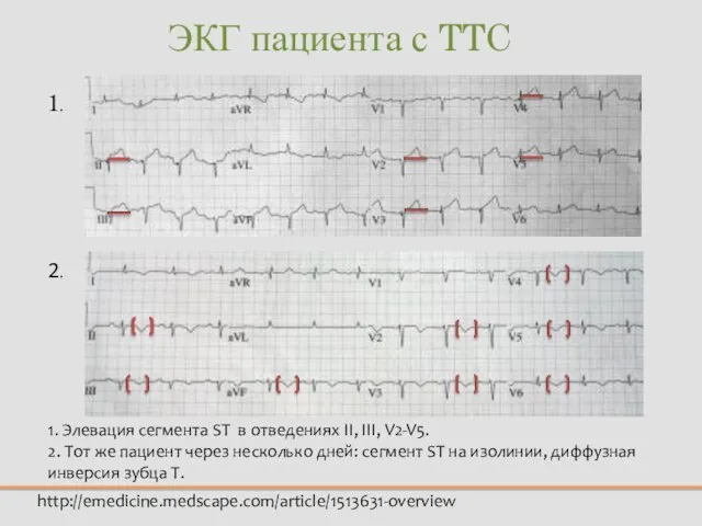 ЭКГ пациента с TTC http://emedicine.medscape.com/article/1513631-overview 1. 2. 1. Элевация сегмента ST