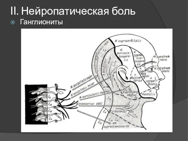 II. Нейропатическая боль Ганглиониты