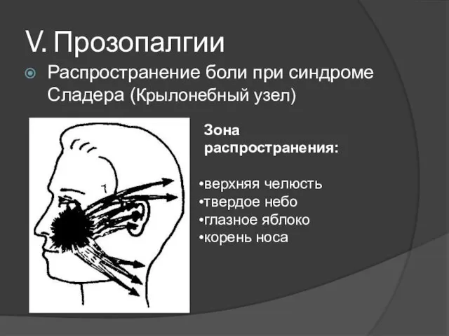 V. Прозопалгии Распространение боли при синдроме Сладера (Крылонебный узел) Зона распространения: