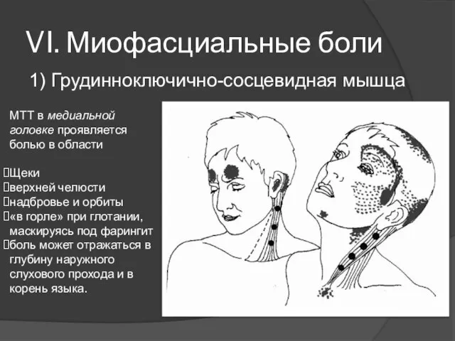 VI. Миофасциальные боли 1) Грудинноключично-сосцевидная мышца МТТ в медиальной головке проявляется