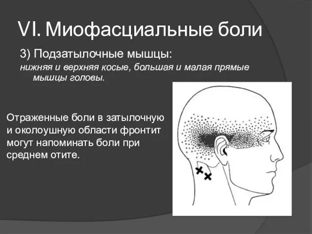 VI. Миофасциальные боли 3) Подзатылочные мышцы: нижняя и верхняя косые, большая