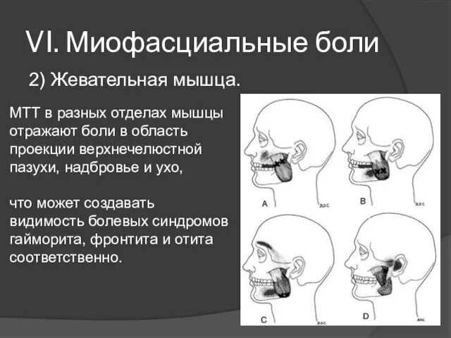 VI. Миофасциальные боли 2) Жевательная мышца. МТТ в разных отделах мышцы