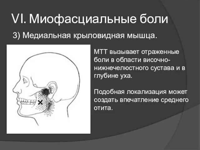 VI. Миофасциальные боли 3) Медиальная крыловидная мышца. МТТ вызывает отраженные боли