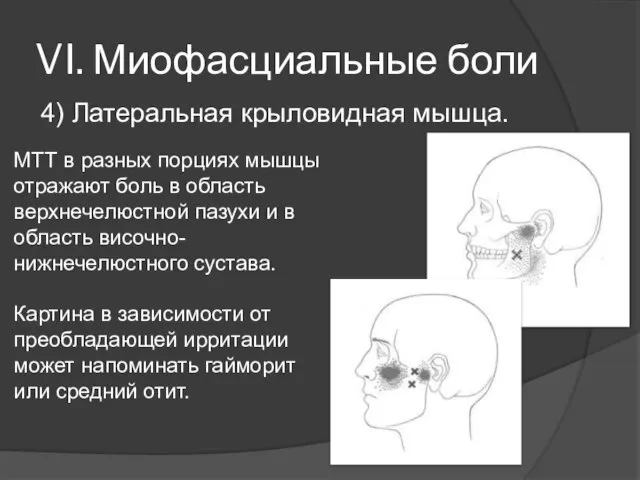 VI. Миофасциальные боли 4) Латеральная крыловидная мышца. МТТ в разных порциях