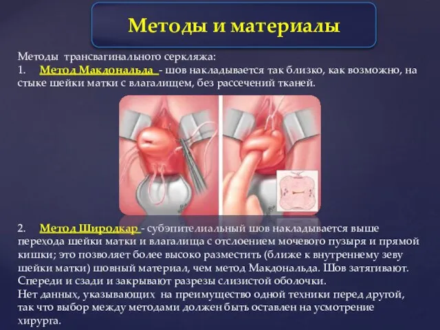 Методы трансвагинального серкляжа: 1. Метод Макдональда - шов накладывается так близко,