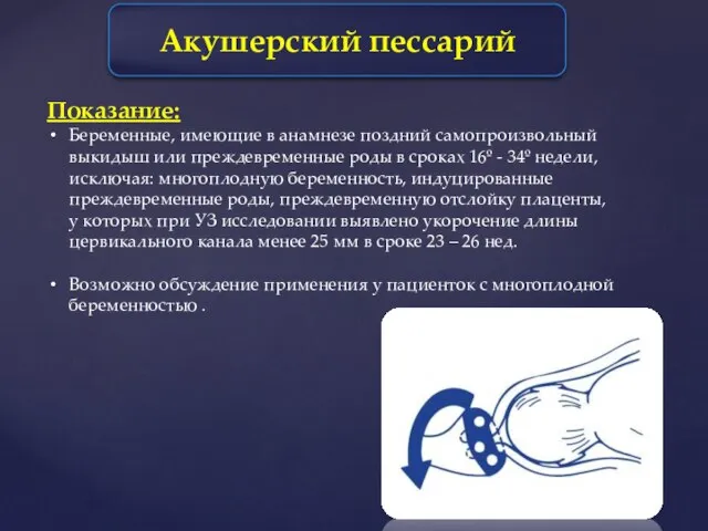 Акушерский пессарий Показание: Беременные, имеющие в анамнезе поздний самопроизвольный выкидыш или