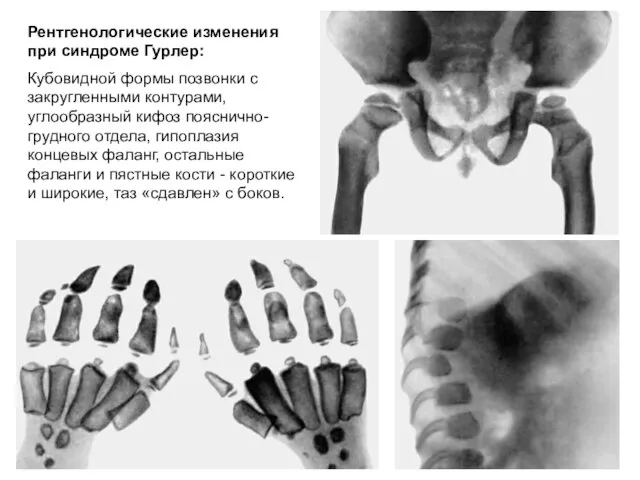 Рентгенологические изменения при синдроме Гурлер: Кубовидной формы позвонки с закругленными контурами,