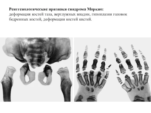 Рентгенологические признаки синдрома Моркио: деформация костей таза, вертлужных впадин, гипоплазия головок бедренных костей, деформация костей кистей.