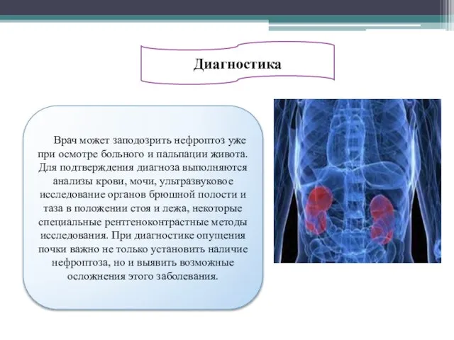 Диагностика Врач может заподозрить нефроптоз уже при осмотре больного и пальпации
