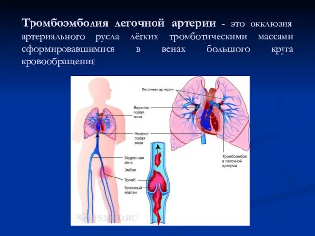 Тромбоэмболия легочной артерии - это окклюзия артериального русла лёгких тромботическими массами