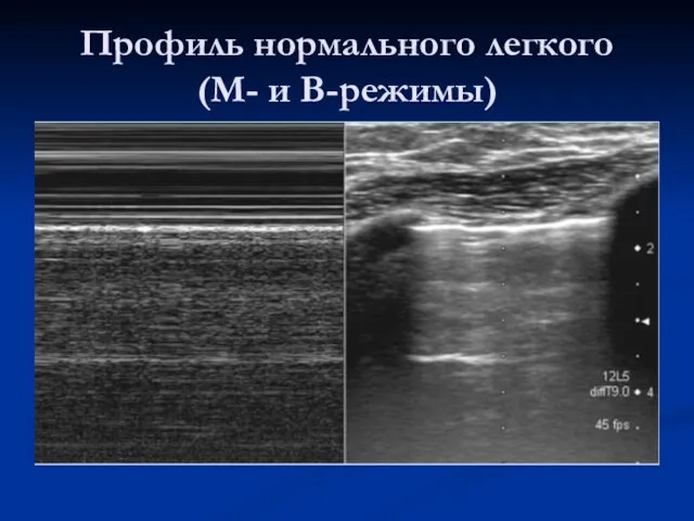 Профиль нормального легкого (М- и В-режимы)