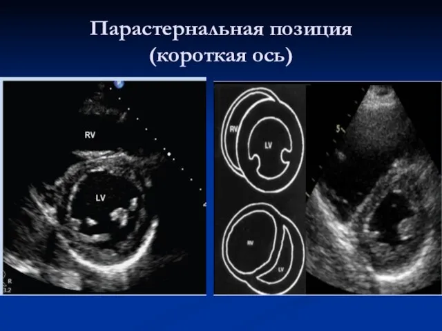 Парастернальная позиция (короткая ось)