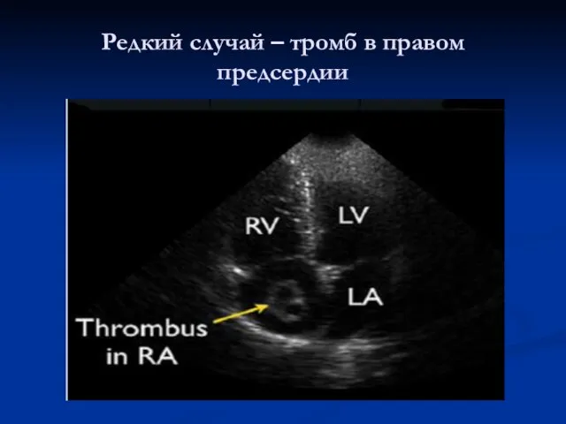 Редкий случай – тромб в правом предсердии