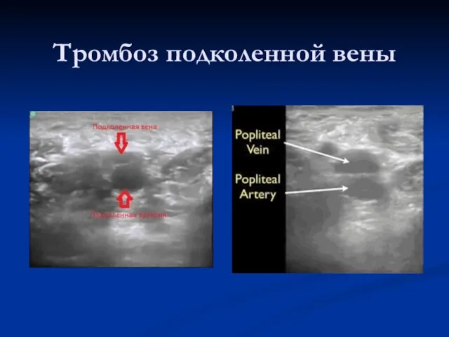 Тромбоз подколенной вены