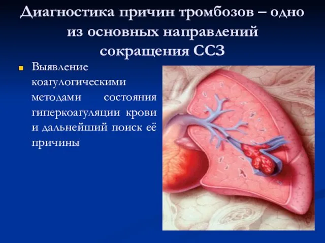 Диагностика причин тромбозов – одно из основных направлений сокращения ССЗ Выявление