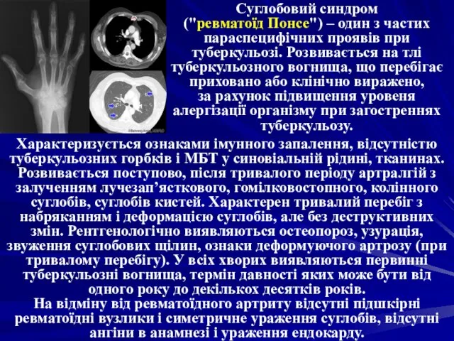 Суглобовий синдром ("ревматоїд Понсе") – один з частих параспецифічних проявів при