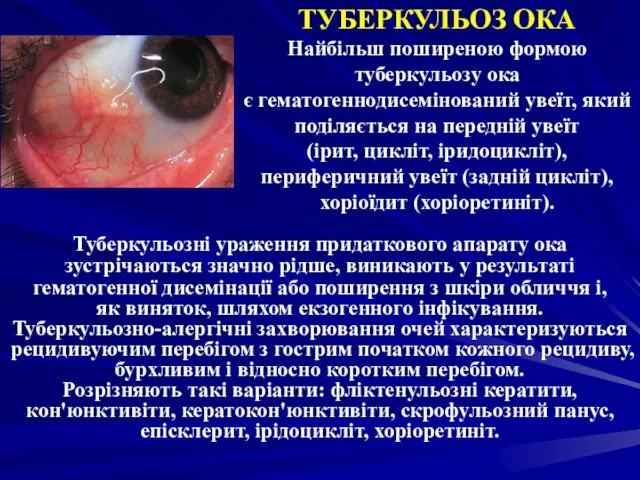 ТУБЕРКУЛЬОЗ ОКА Найбільш поширеною формою туберкульозу ока є гематогеннодисемінований увеїт, який