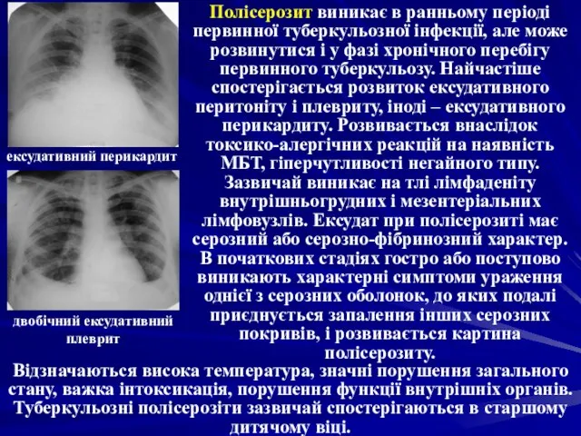 Полісерозит виникає в ранньому періоді первинної туберкульозної інфекції, але може розвинутися