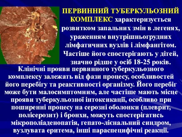 ПЕРВИННИЙ ТУБЕРКУЛЬОЗНИЙ КОМПЛЕКС характеризується розвитком запальних змін в легенях, ураженням внутрішньогрудних