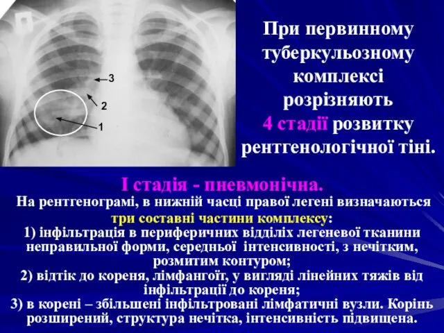 При первинному туберкульозному комплексі розрізняють 4 стадії розвитку рентгенологічної тіні. І