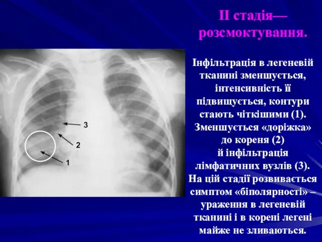 II стадія—розсмоктування. Інфільтрація в легеневій тканині зменшується, інтенсивність її підвищується, контури