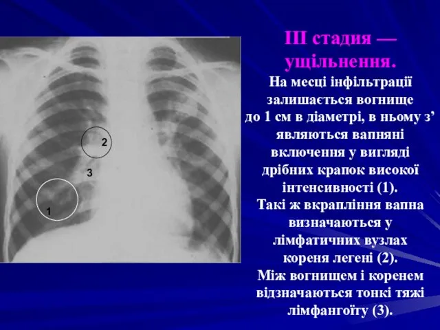 III стадия — ущільнення. На месці інфільтрації залишається вогнище до 1