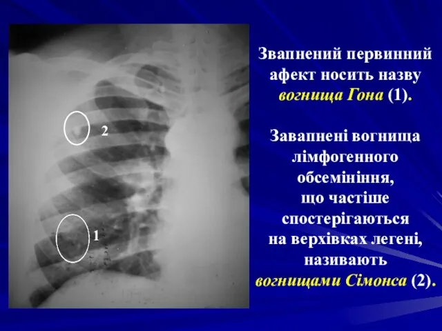 Звапнений первинний афект носить назву вогнища Гона (1). Завапнені вогнища лімфогенного