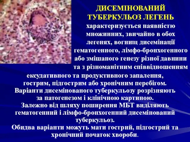 ДИСЕМІНОВАНИЙ ТУБЕРКУЛЬОЗ ЛЕГЕНЬ характеризується наявністю множинних, звичайно в обох легенях, вогнищ