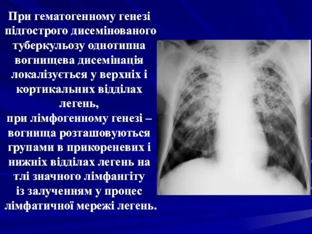 При гематогенному генезі підгострого дисемінованого туберкульозу однотипна вогнищева дисемінація локалізується у