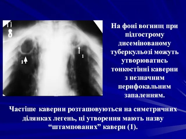 На фоні вогнищ при підгострому дисемінованому туберкульозі можуть утворюватись тонкостінні каверни