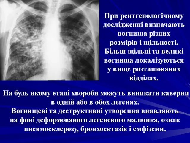 При рентгенологічному дослідженні визначають вогнища різних розмірів і щільності. Більш щільні