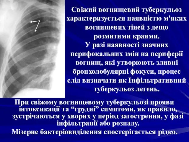 Свіжий вогнищевий туберкульоз характеризується наявністю м'яких вогнищевих тіней з дещо розмитими